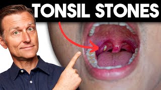 Tonsil Stones: Removing The Deeper Cause