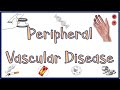 Peripheral Vascular Disease(PVD): Causes, Signs & Symptoms, Diagnosis &Treatment