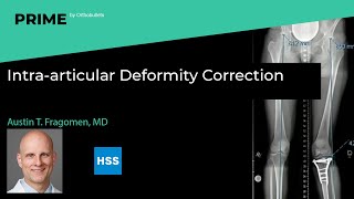 Intra-articular Deformity Correction - Austin T. Fragomen, MD