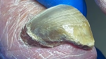 Thick, Greenish Toenail Fungus; Complete Pedicure Process【Pedicure Master Lin Jun】