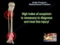 Ankle Fracture Maisonneuve Fracture - Everything You Need To Know - Dr. Nabil Ebraheim