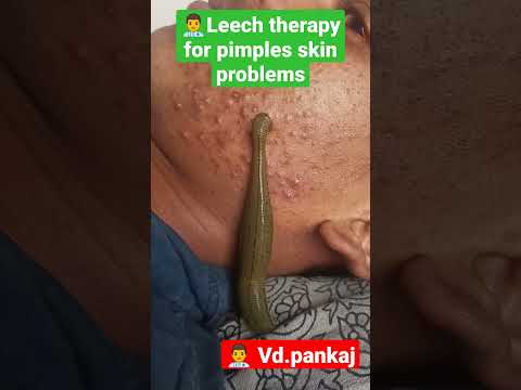 leech therapy for skin problems #pimples #ayurveda #skinproblems #shorts #panchkarma #hairfall #mp