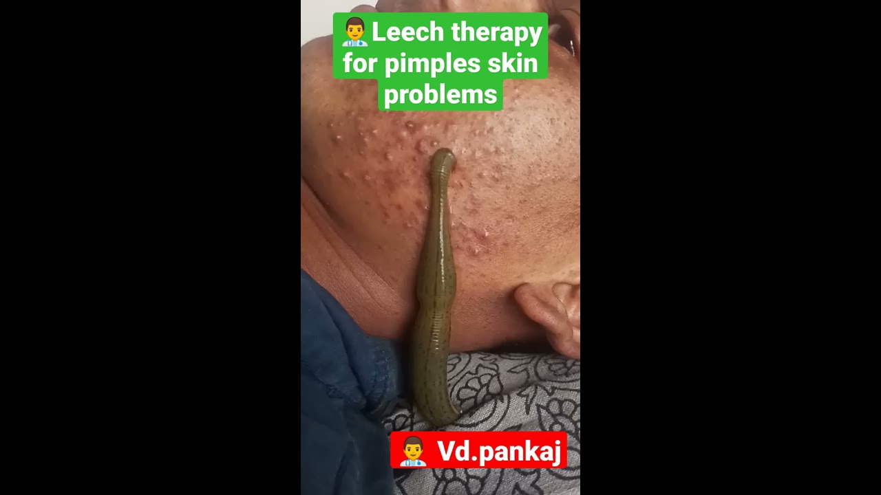 leech therapy for skin problems #pimples #ayurveda #skinproblems #shorts #panchkarma #hairfall #mp