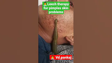 Leech Therapy For Skin Problems Pimples Ayurveda Skinproblems Shorts Panchkarma Hairfall Mp 