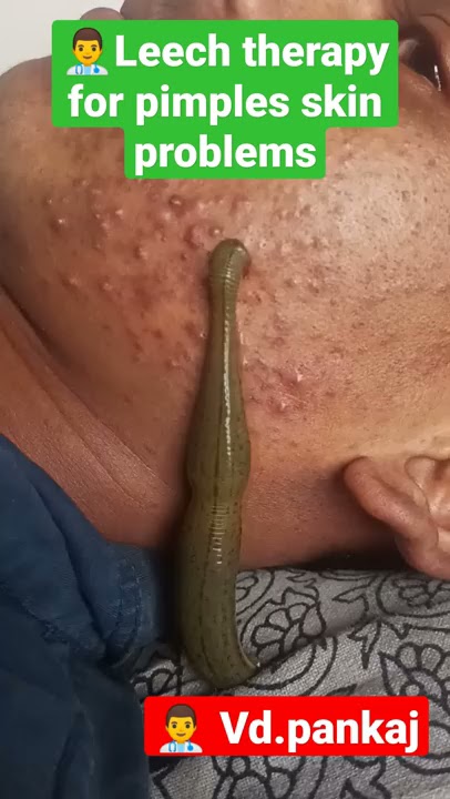 leech therapy for skin problems #pimples #ayurveda #skinproblems #shorts #panchkarma #hairfall #mp