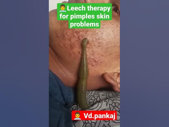 leech therapy for skin problems #pimples #ayurveda #skinproblems #shorts #panchkarma #hairfall #mp