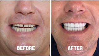 Hollywood Smile (Zirconium Crowns) - Andrew From Manchester.