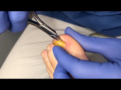 Usuwanie wrastającego fragmentu paznokcia - Ingrown toenail removal