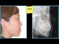 CC309. Occlusal Canting & Wrong Angulation