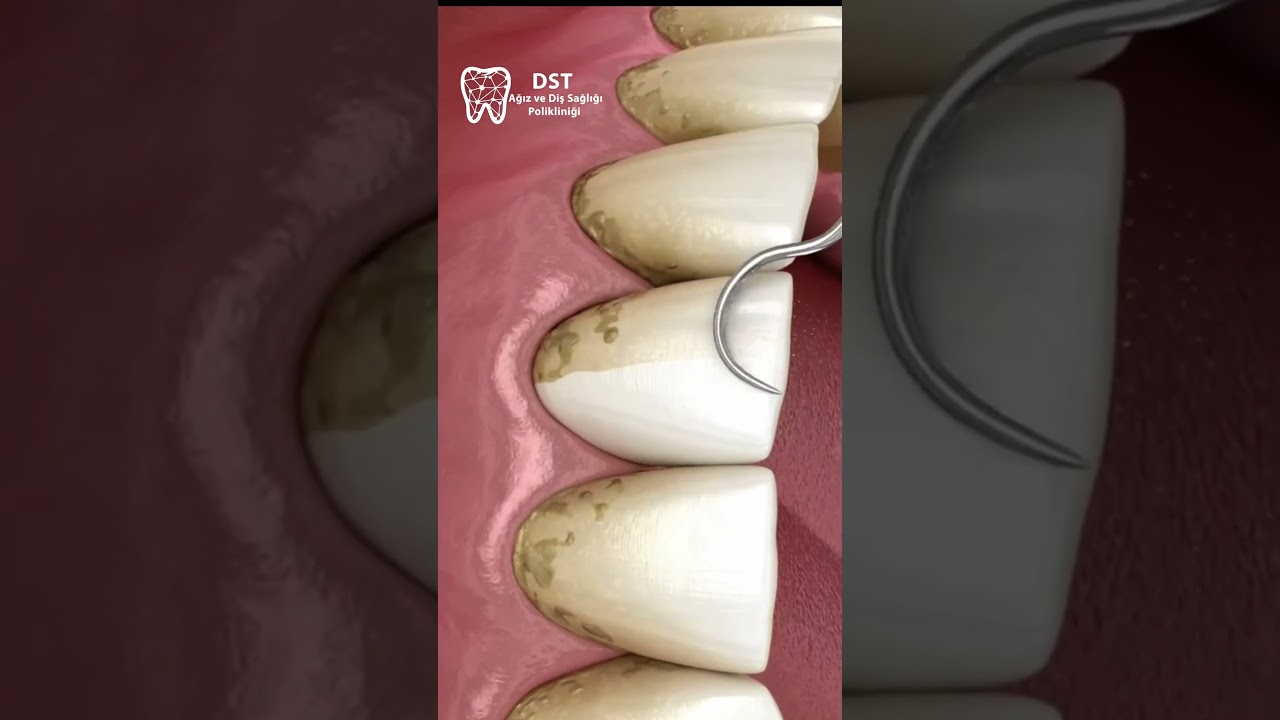 Diş Temizleme Nasıl Yapılır ? 