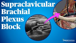 Supraclavicular Brachial Plexus Block