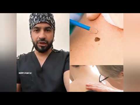 الشامات الغير طبيعية في الوجه والجسم