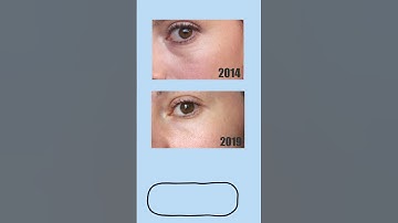 Getting Rid of Wrinkles with Chemical Peels (At Home)