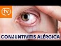 Claves sobre la conjuntivitis alérgica