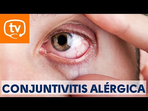 Vídeo: Aceites Esenciales Para La Conjuntivitis: Remedios Y Precauciones En El Hogar