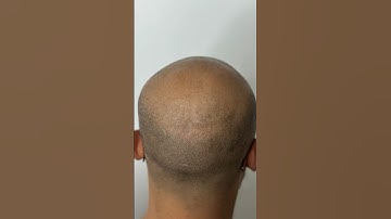 Scalp micropigmentation in crown region, #scalpmicropigmentationindia #scalpmicropigmentation #smp