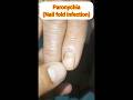 नाखुन(nail) की ये कैसी बिमारी ? #nail #nailcare #pain #shorts #shortvideo #shortsfeed #ytshorts