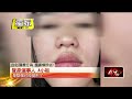 獨家／赴韓打童顏針踩雷　正妹慘變「釋迦臉」 還影響視力