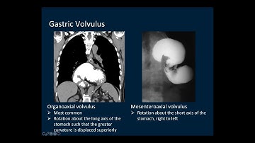 Imaging disease of stomach