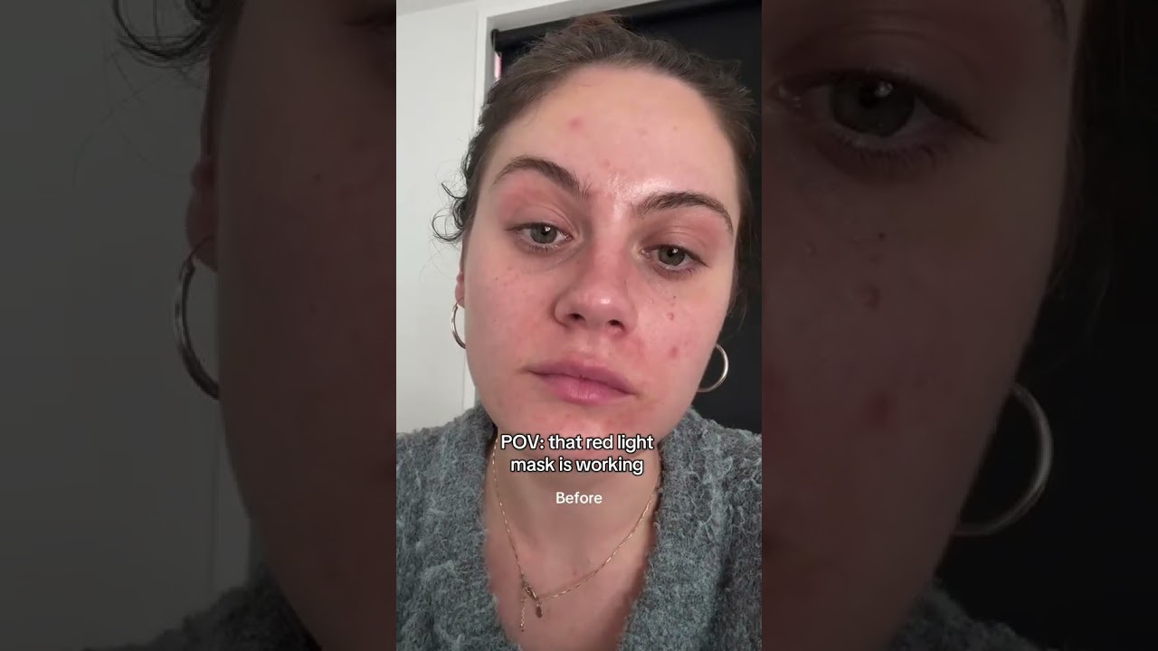 Red Light Therapy Before and After