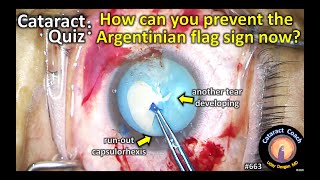 Cataract Quiz: how do you prevent Argentinian Flag Sign in white cataracts?