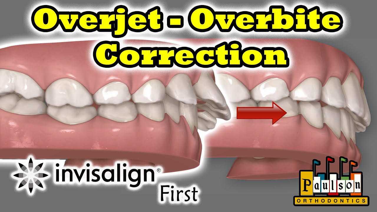 Overjet and Overbite Correction Invisalign First system instead of braces Phase 1 10 year