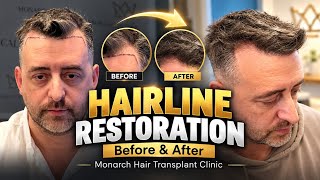 From Receding Hairline to Natural Result | FUE Hair Transplant Before & After