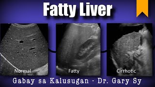 Fatty Liver - Dr. Gary Sy