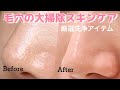 【いちご鼻・黒ずみ】効果が目に見える♡毛穴ケアができるスキンケアアイテムを徹底調査！