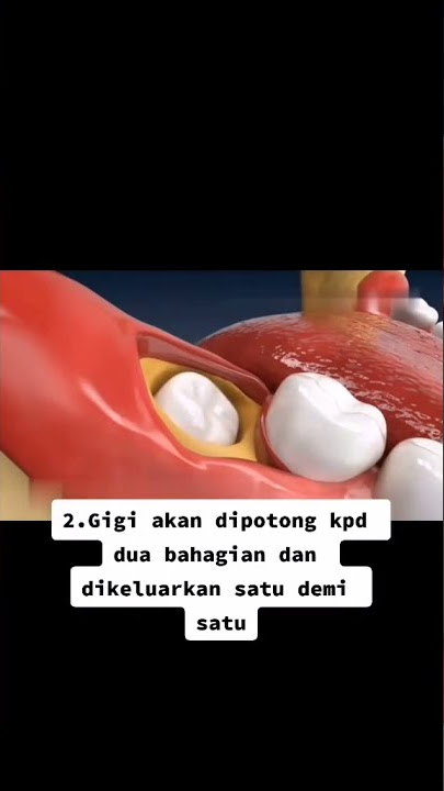 Proses gigi geraham bongsu dicabut