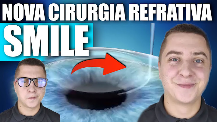 NOVA CIRURGIA REFRATIVA: SMILE