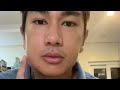 Nikko Natividad, Namaga ang Pisngi 😲