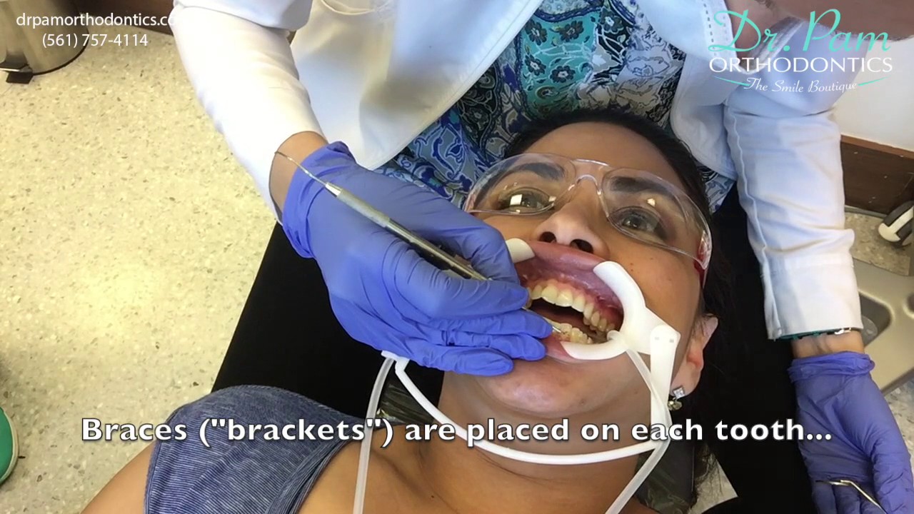 Orthodontics bonding appointment: placing clear (invisible) braces step-by-step.