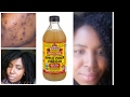 HOW I CLEARED MY ACNE WITH APPLE CIDER VINEGAR  Toner! DIY