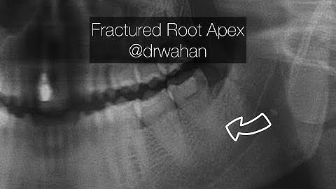 Fractured Root Near Apex