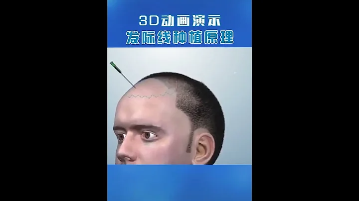 植髮 ：3D演示過程 - 天天要聞