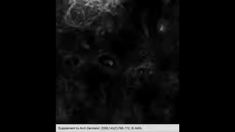 Reflectance Confocal Microscopy Criteria for Squamous Cell Carcinomas and Actinic Keratoses