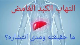 التهاب الكبد الغامض Mysterious hepatitis