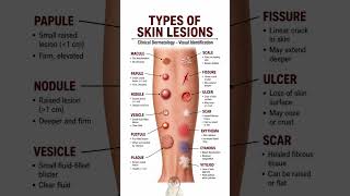 TYPES OF SKIN LESIONS