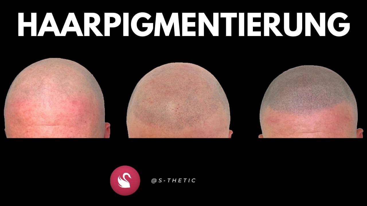 Haarpigmentierung / Mikro-Haarpigmentierung