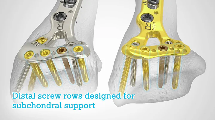 Acu-Loc® 2 Wrist Plating System with 2.7 mm Low Profile Hexalobe Screws Overview Animation