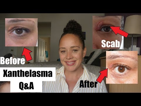 فيديو: كيفية إزالة Xanthelasma: 8 خطوات (بالصور)