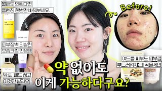 3년간의 여드름 3주만에 없앤 기적의 루틴;;; 뭘해도…