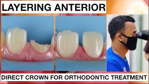 Step by step Layering Anterior Direct Crown Composite | General Dentist Griya RR