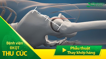 Phẫu thuật "Thay khớp háng nhân tạo" tại BV Thu Cúc khôi phục khả năng vận động