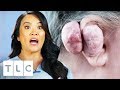 Dr. Lee Removes 14 Oz Keloid From Woman's Ear | Dr. Pimple Popper