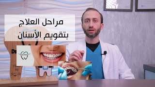 مراحل العلاج بتقويم الأسنان من تركيب تقويم الاسنان إلى انتهاء العلاج والمثبت screenshot 5