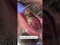 Vertical tooth fracturedo you have any root canal treated tooth no crown 