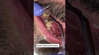 Vertical tooth fracture!do you have any root canal treated tooth? No Crown ? Resimi