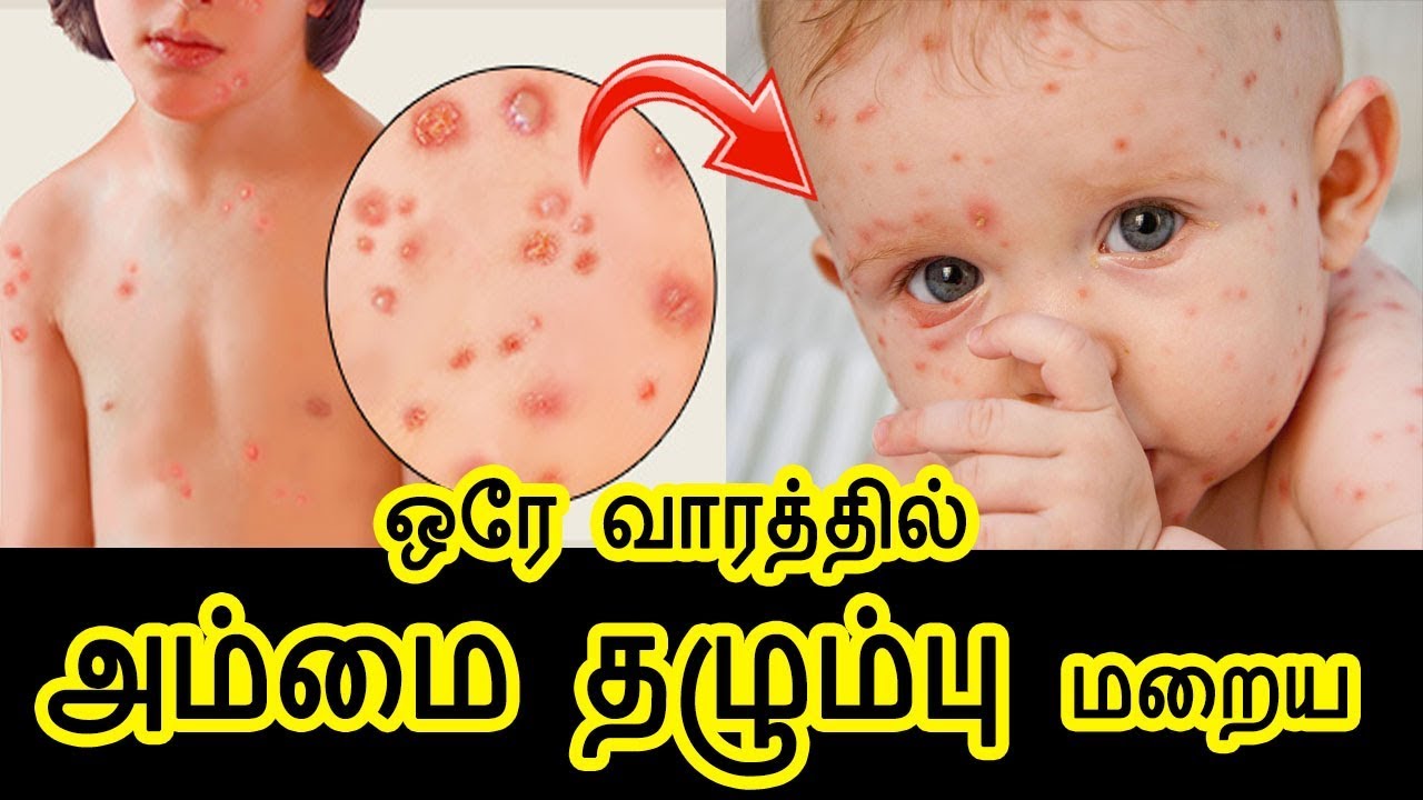 Remove Chicken Pox Marks in Tamil Chicken Pox Scar Removal அம்மை